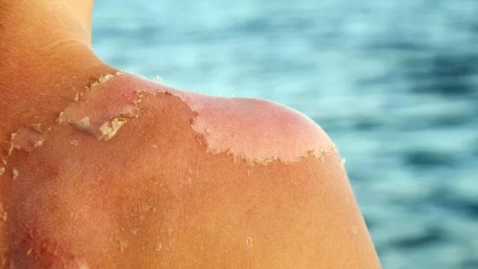 A pele lesionada pelo sol libera substâncias que contribuem para as inflamações sistêmicas, aumentando o risco de quase todas as doenças do envelhecimento — Foto: Getty Images via BBC News