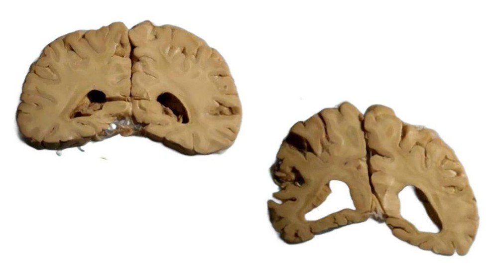 À esquerda, cérebro saudável de uma freira de 90 anos; à direita, cérebro de uma freira de 89 anos com Alzheimer: o cérebro de quem sofreu de Alzheimer é mais leve, porque as células morrem e ficam ocas — Foto: Getty Images (via BBC)