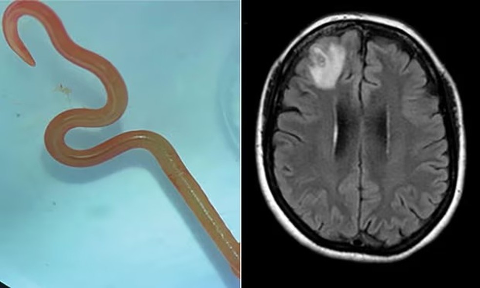 O espécime de "Ophidascaris robertsi" que foi extraído vivo do cérebro da mulher por cirurgiões no hospital de Canberra — Foto: Camberra Health
