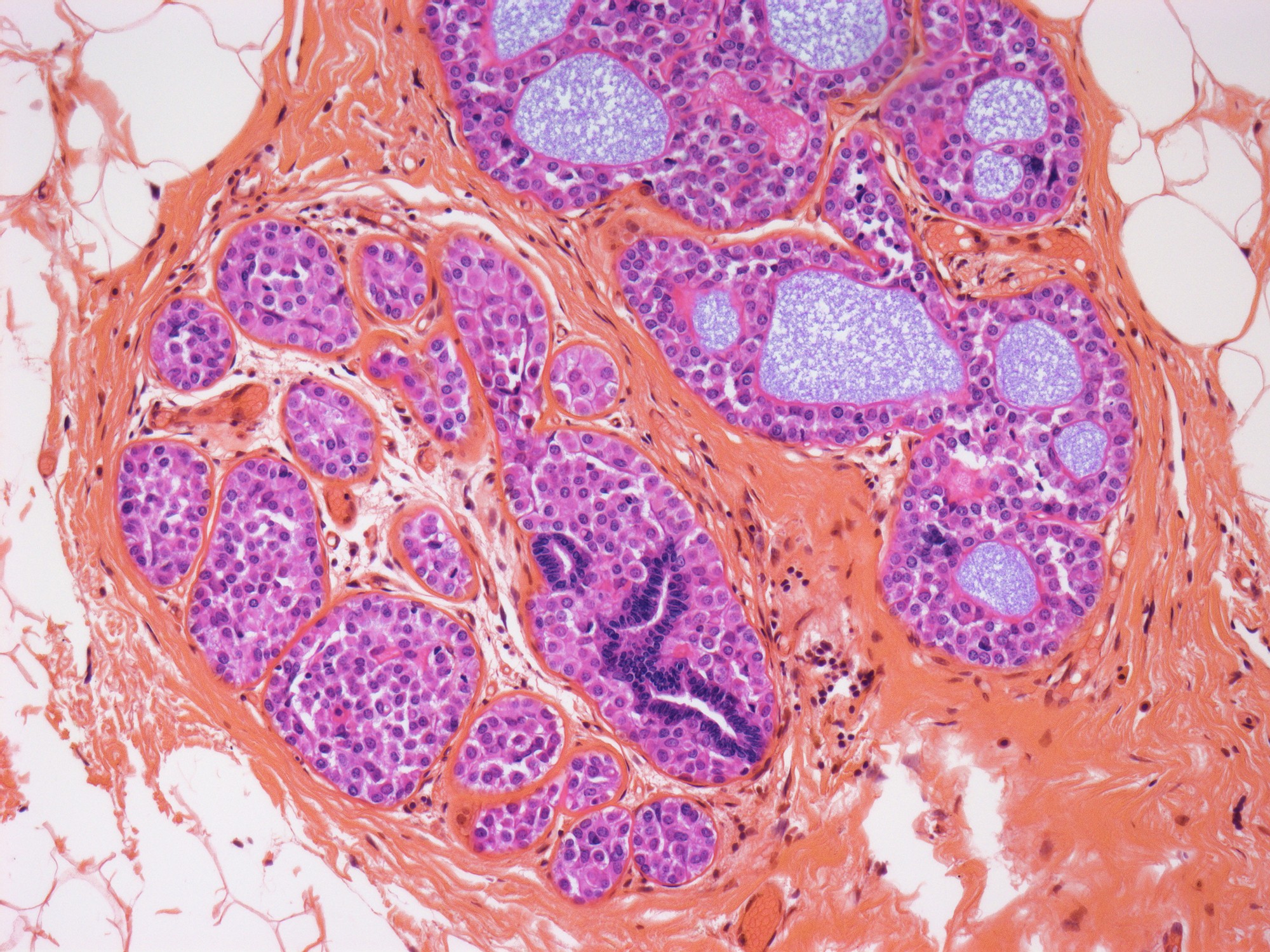 Nanopartículas usam estresse do próprio câncer para matar tumores e poupar células saudáveis