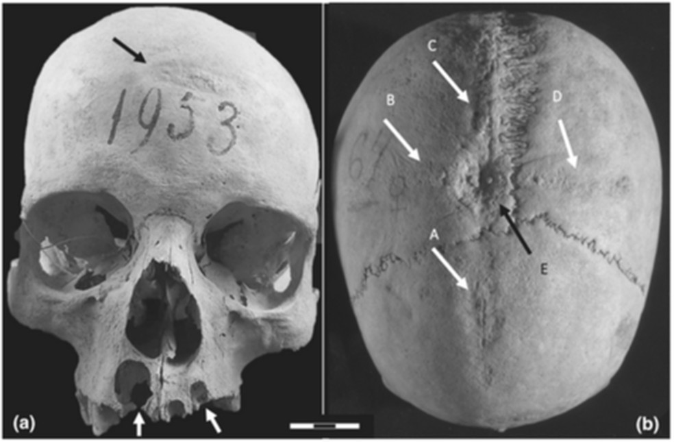 Crânio de mulher da época medieval apresenta sinais de cirurgias  — Foto: Divulgação/Universidade Sapienza