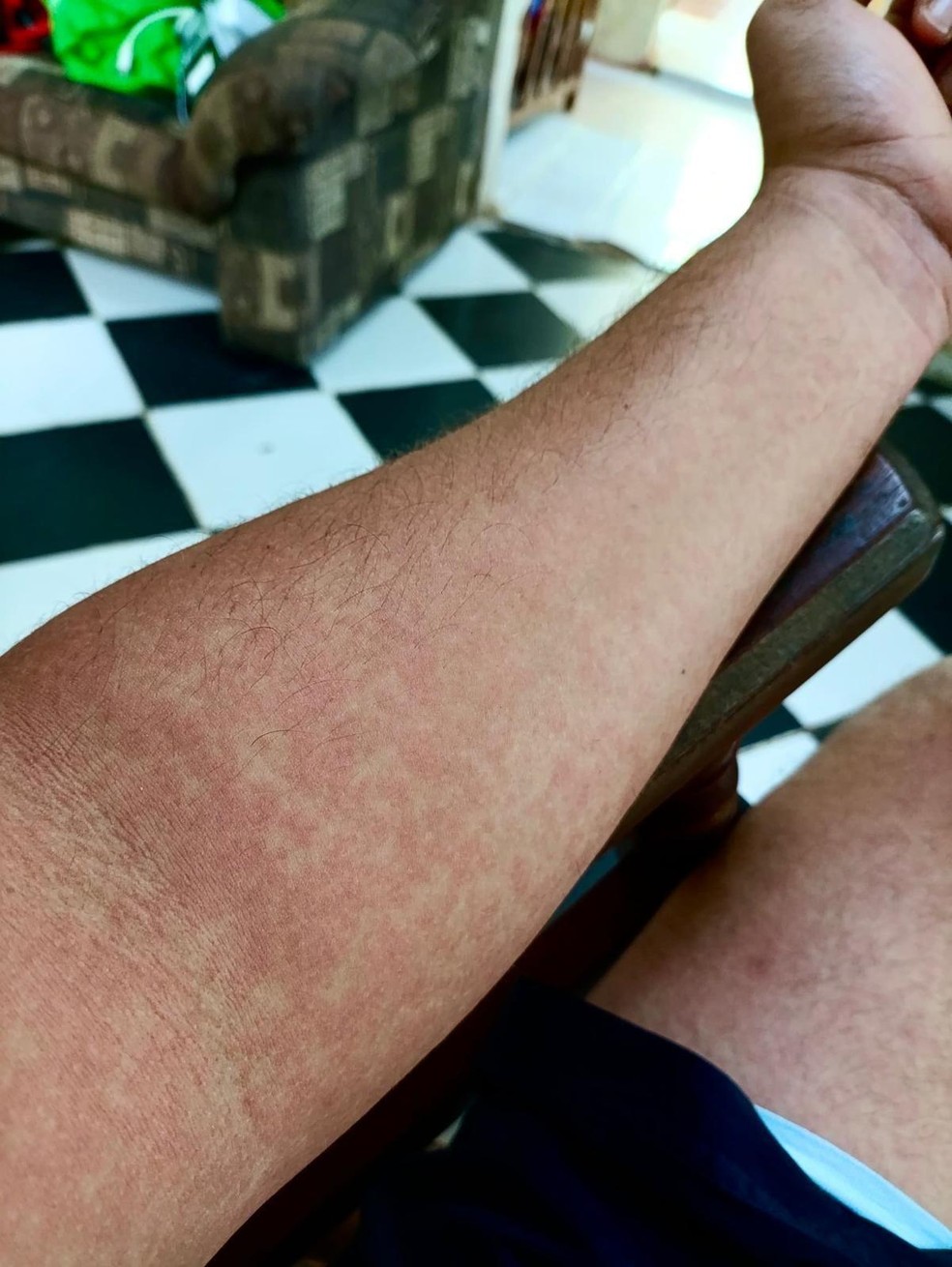 Após vários dias de dores e febre, Hansel apresentou manchas na pele por todo o corpo — Foto: BBC News fonte