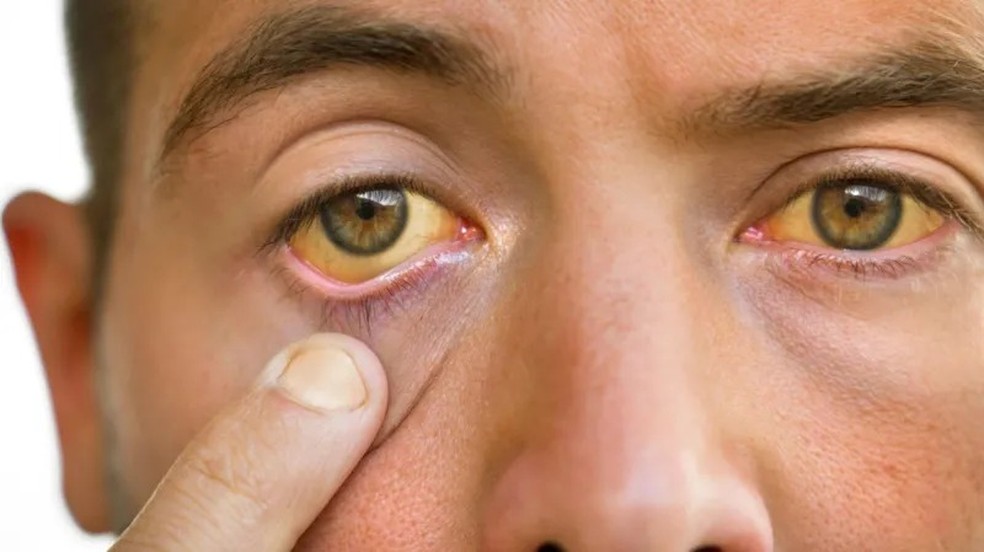 Pele e olhos amarelos podem ser sinais de um fígado danificado — Foto: GETTY IMAGES via BBC