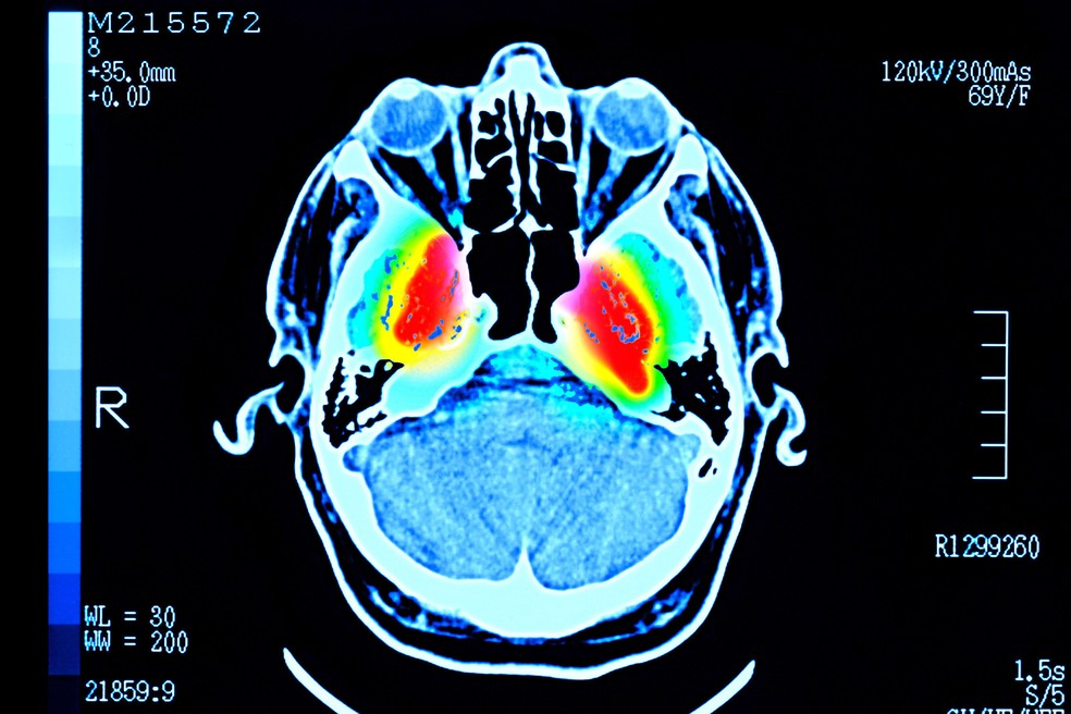 Os pesquisadores afirmam que os resultados podem ajudar a entender por que o risco de transtornos mentais e demência varia ao longo da vida — Foto: BBC News fonte