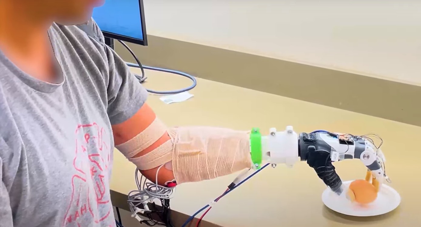 Prótese de mão com inteligência artificial aprende sozinha e reduz esforço mental
