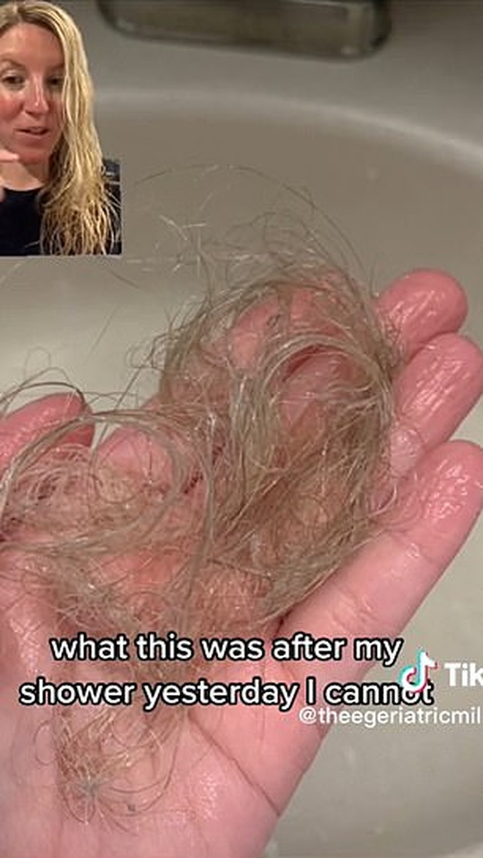 Usuária de remédio para emagrecer relata perda de cabelo  — Foto: Reprodução/Redes sociais 