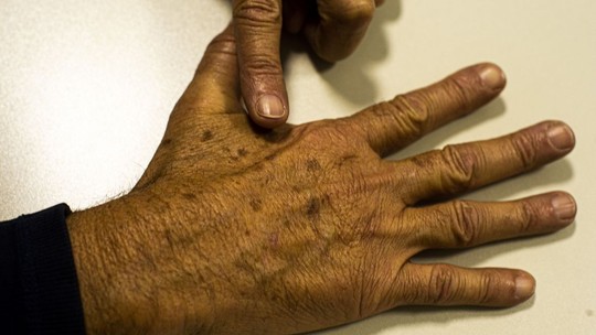 Merck encerra estudo do uso do medicamento Keytruda em pacientes com câncer de pele