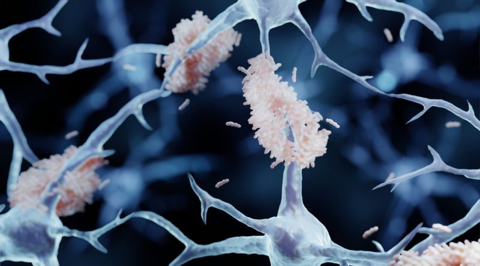 Acúmulo de placas formadas pela proteína beta-amiloide (em rosa) no cérebro — Foto: Getty Images (via BBC)