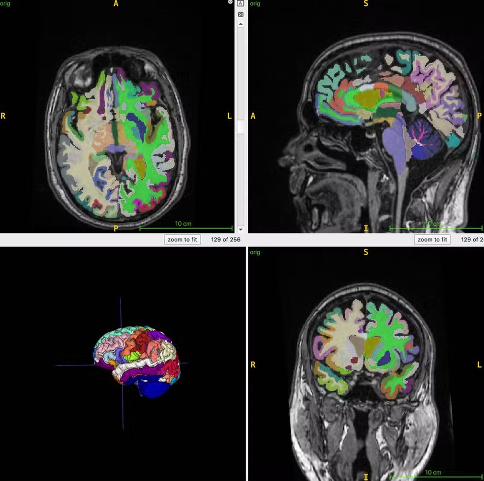 Imagens da figura do cérebro em cores na ressonância magnética usados para cálculos da idade cerebral — Foto: Cyrus Raji/ Sociedade Radiológica da América do Norte (RSNA)