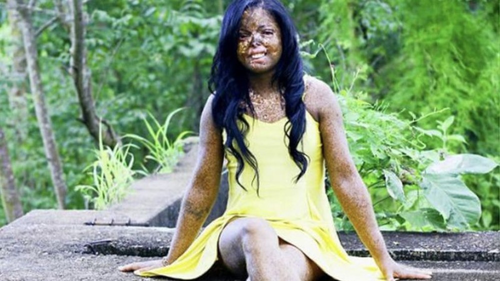 Xeroderma pigmentoso: 'Troco dia pela noite', diz mulher que sofre com ...