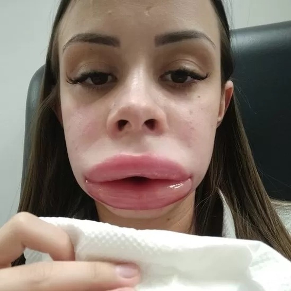 Após preenchimento labial, Pamela Andrade teve forte inchaço na boca, no rosto, nos olhos — Foto: Arquivo pessoal via BBC News