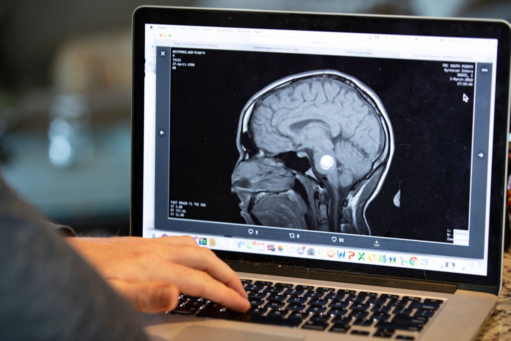 Picos de glicose após as refeições podem aumentar risco de Alzheimer, aponta estudo